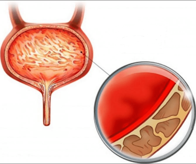 Inflammation de la cystite